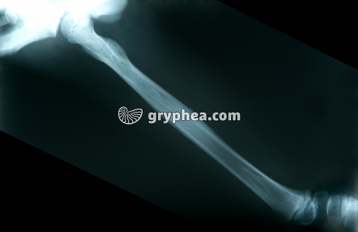 Radiographie de Fémur consolidé - gryphea.com